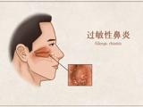 夏季过敏二三事