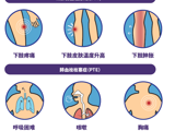 认识血栓，从预防开始